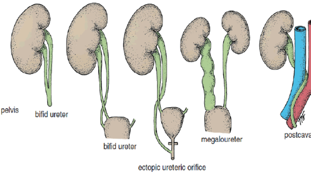 DOĞUŞTAN BÖBREK ANORMALLİKLERİ
