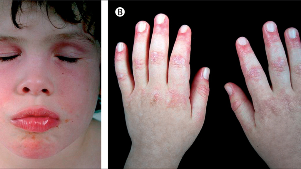 JÜVENİL DERMATOMİYOZİT