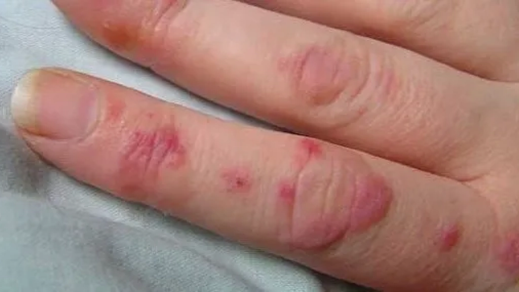 Sistemik Lupus Eritematozis