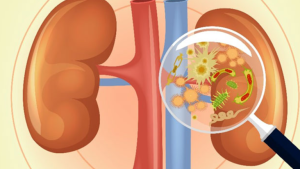 ÇOCUKLARDA ÜRİNER OBSTRÜKSİYONLAR