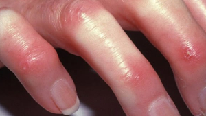 JUVENiL SiSTEMiK SKLEROSiS (SKLERODERMA)