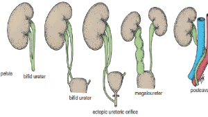 DOĞUŞTAN BÖBREK ANORMALLİKLERİ