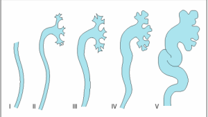 VCUG: Voiding Sistoüretrografi (Sondalı İşeme Filmi)